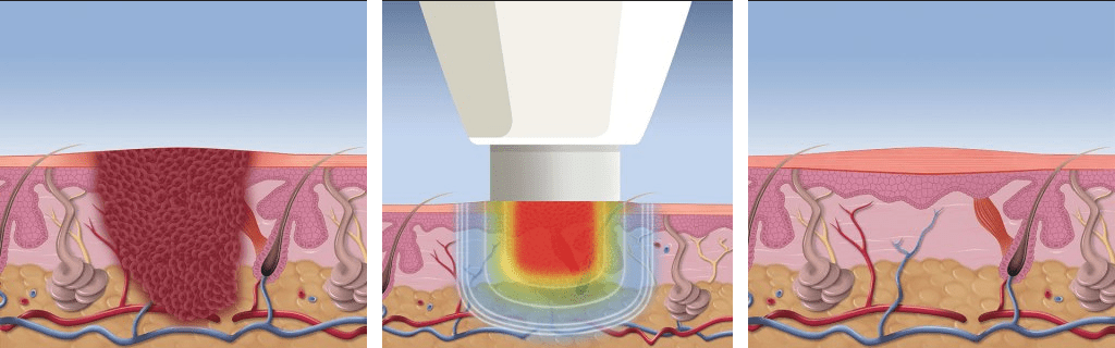 Wart & Verrucae Treatment